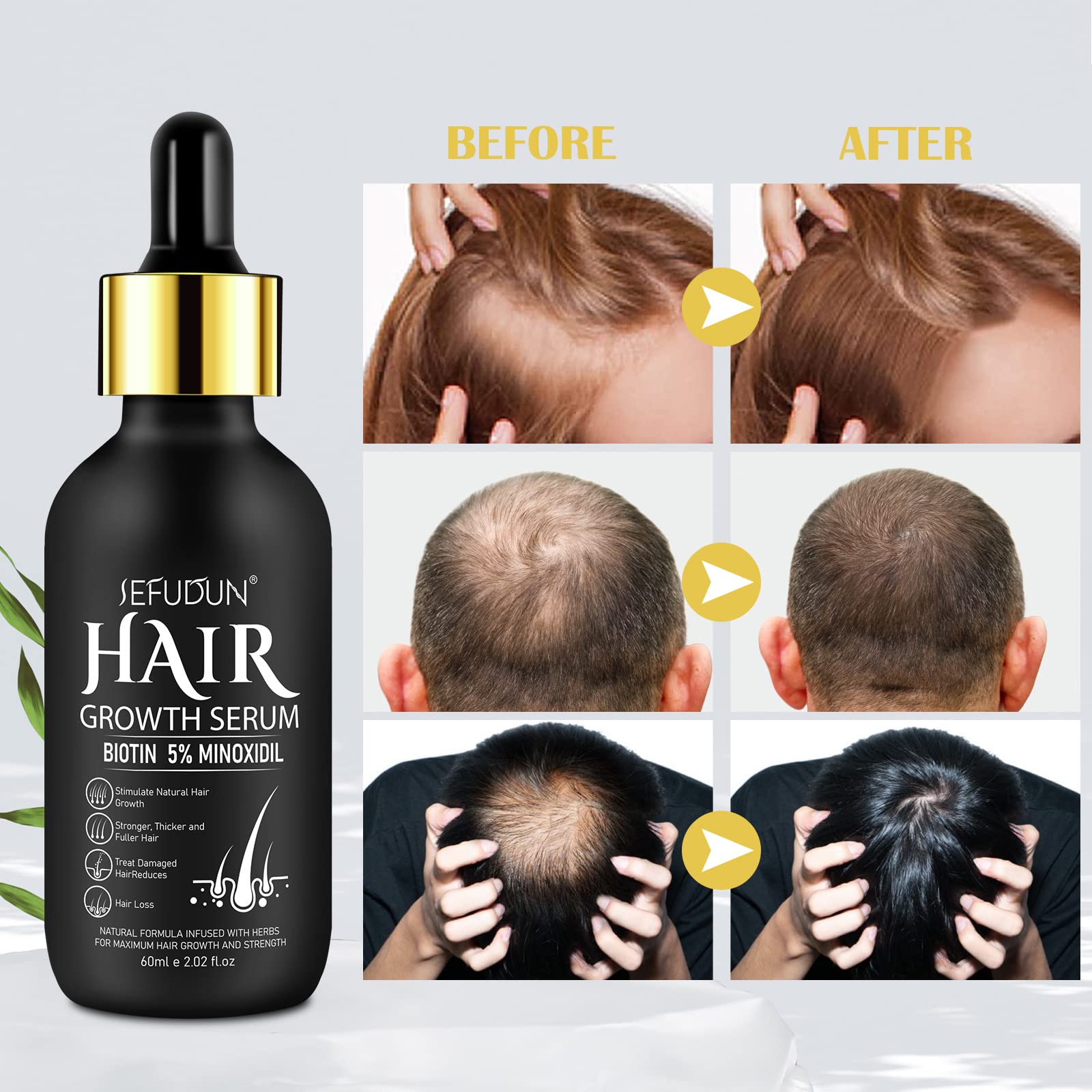 5% Minoxidil for Men and Women Hair Growth Oil with Biotin, Hair Serum for Thicker Fuller Hair, Beard Growth and Hair Regrowth Treatment for Hair Loss - Medaid International