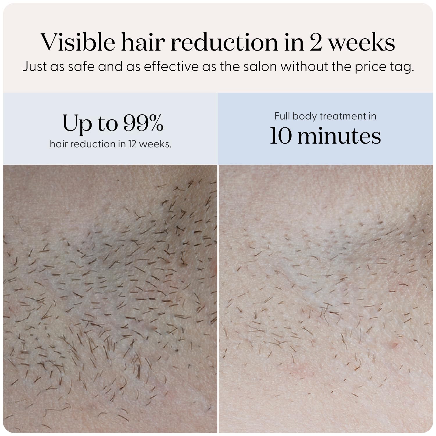 SmoothSkin Pure Fit IPL Hair Removal Device – At-Home Laser Hair Removal for Women & Men, Visible Results in 2 Weeks, Includes Precision Head, Safe for Face & Body, Long-Lasting Hair Reduction - Medaid International