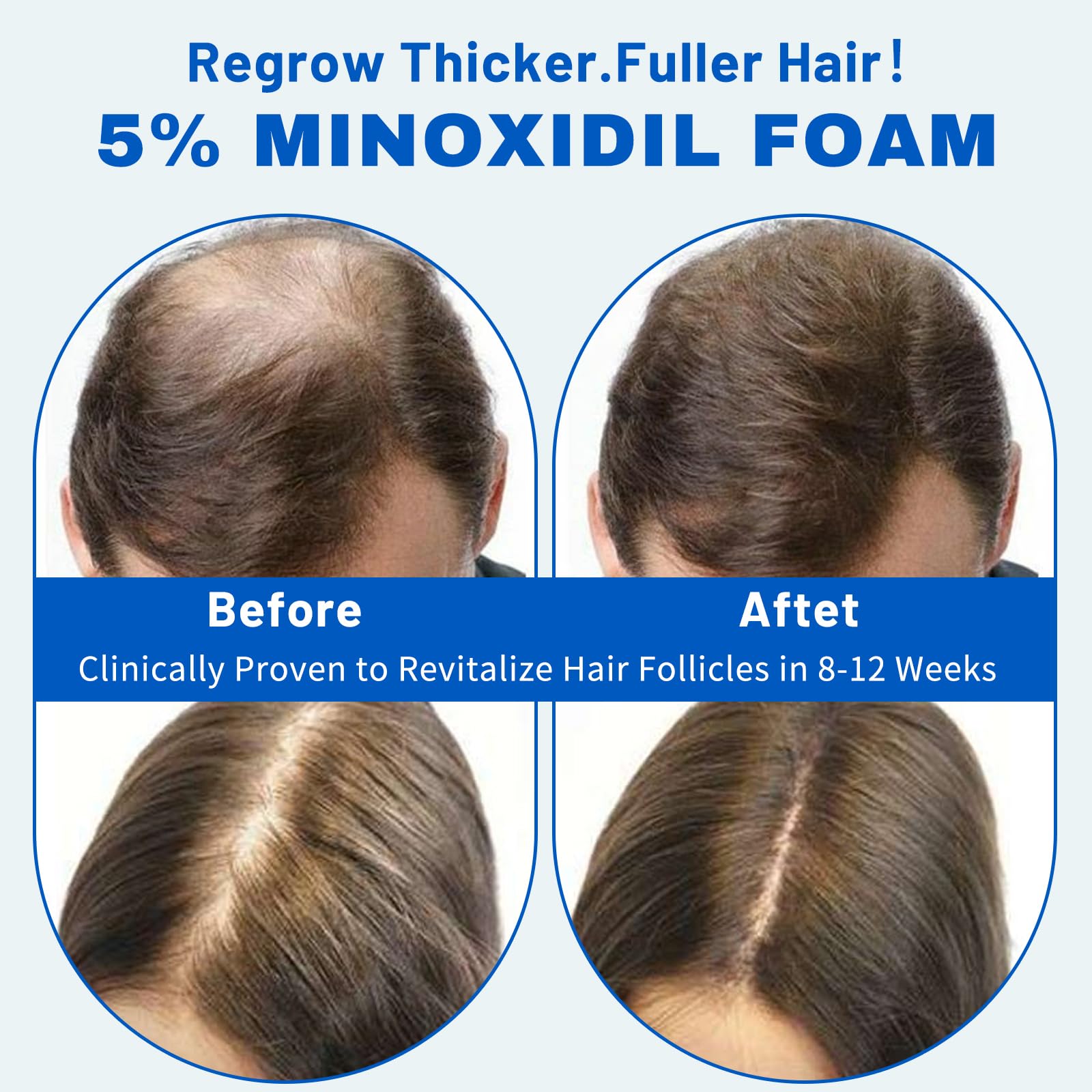 5% Minoxidil Hair Growth Foam for Men & Women – 2 Pack (60ml Each) | Extra Strength Hair Regrowth Treatment with Biotin | Supports Thicker, Fuller-Looking Hair - Medaid International