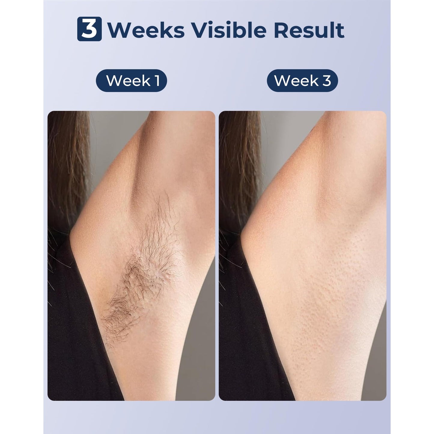 IPL Laser Hair Removal for Women and Men, Sapphire Ice-Cooling Painless, Long-Lasting Result, at Home Hair Removal Device for Legs, Face - Medaid International