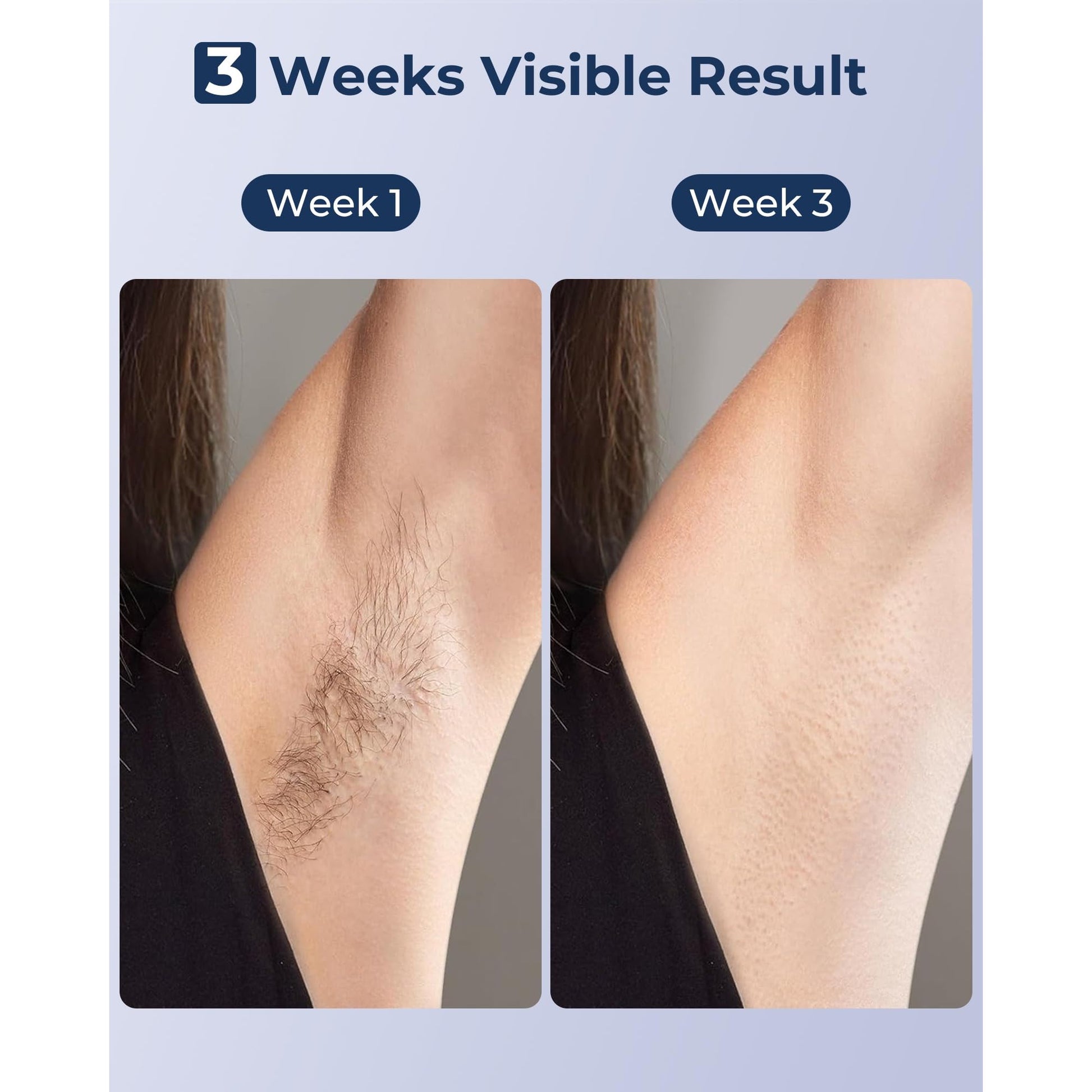 IPL Laser Hair Removal for Women and Men, Sapphire Ice-Cooling Painless, Long-Lasting Result, at Home Hair Removal Device for Legs, Face - Medaid International