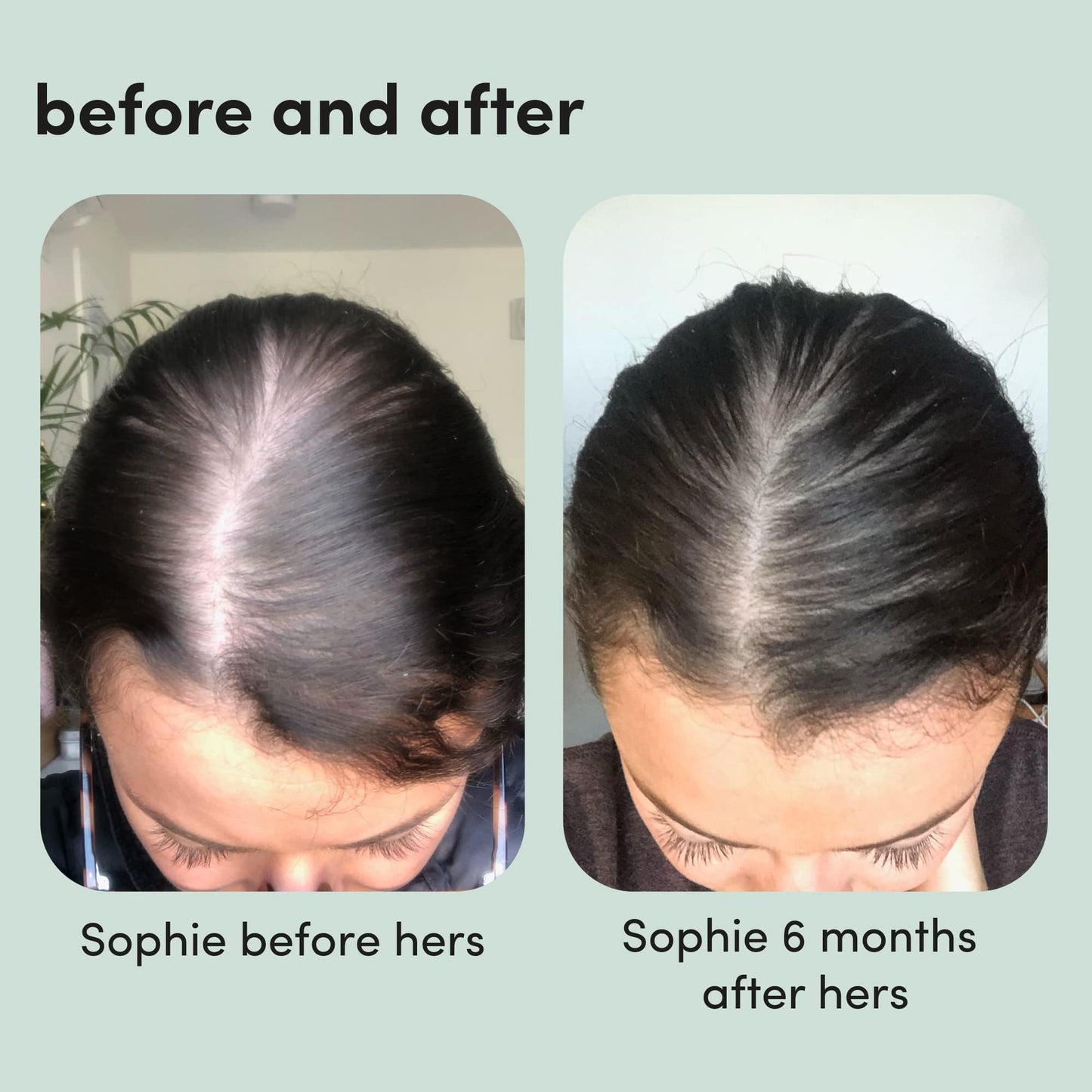 hers Hair Regrowth Treatment - Topical Minoxidil 5% Foam for Women - Extra Strength - Supports Thicker, Fuller Hair - Non-Greasy - Unscented, 2 Pack - Medaid International