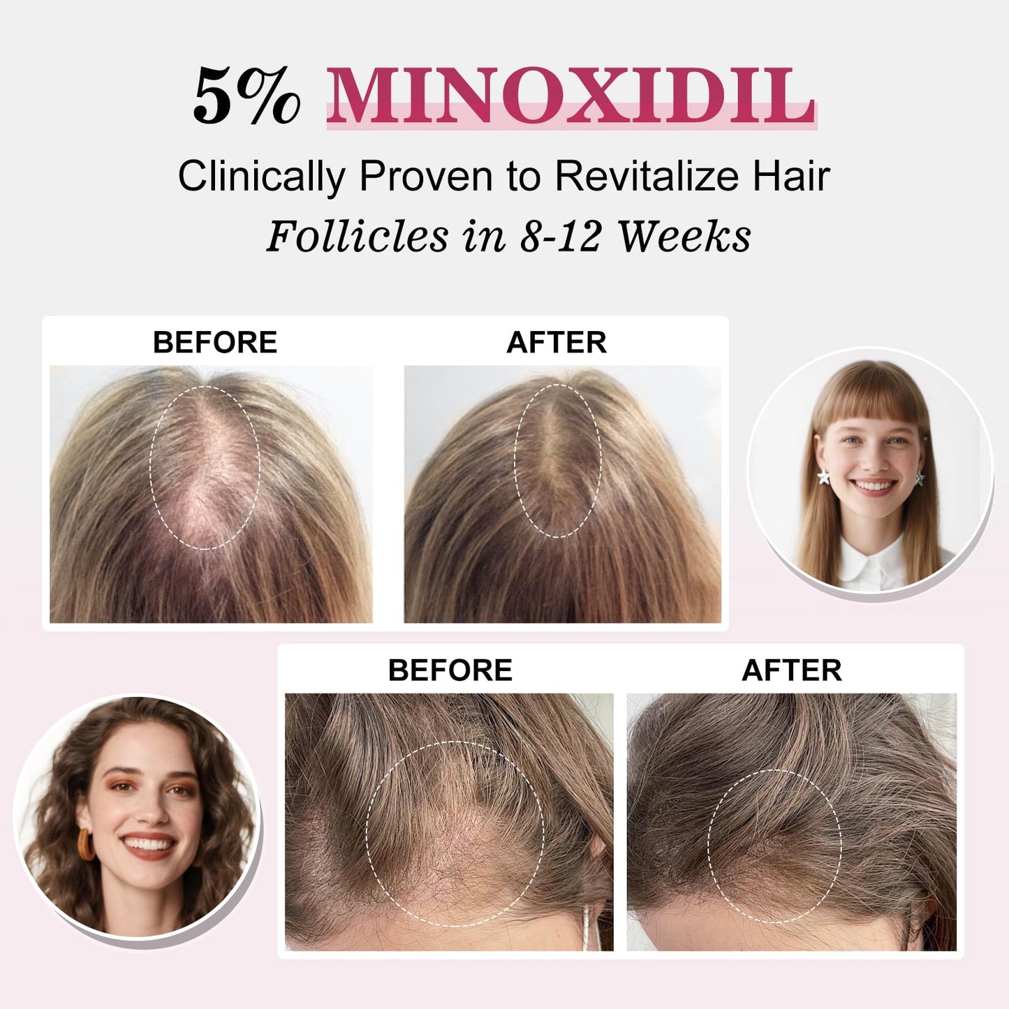 5% Minoxidil for Women Hair Regrowth Spray, hers hair regrowth treatment Infused with Biotin, Extra Strength Treatment to Combat Hair Loss and Thinning, 3 Bottles - Medaid International