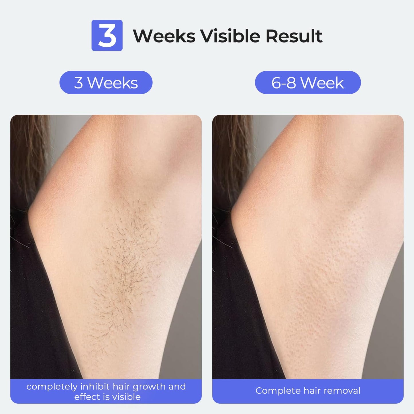 Sapphire Ice Cooling IPL Laser Hair Removal Device at Home for Women and Men, 21J High Energy, 3 Modes, 41°F Cooling Tech, Alternative to Salon Hair Removal for Face, Bikini, Legs - Medaid International