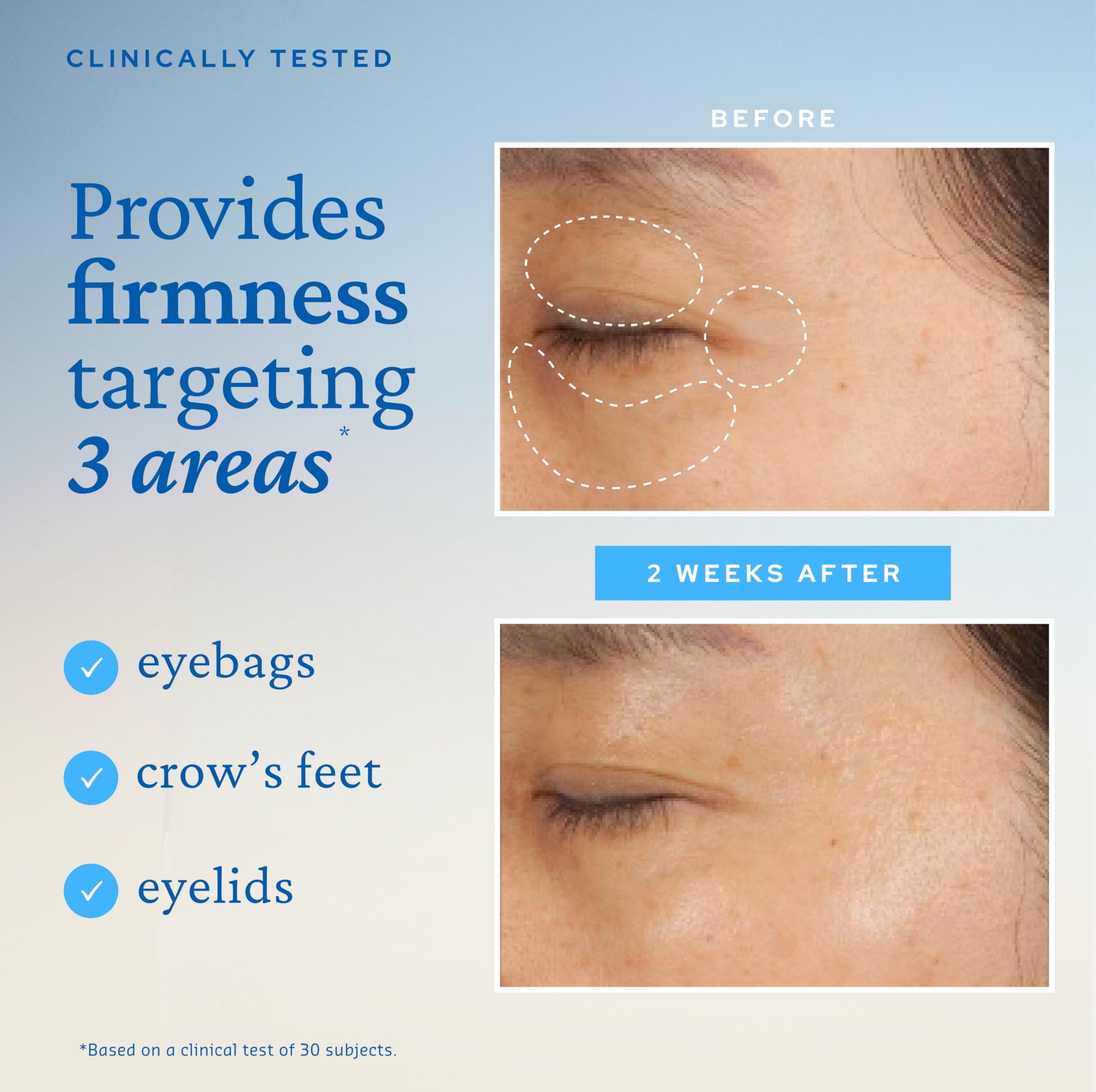 belif Peptide Eye Bomb, Anti-Aging Eye Cream for Wrinkles, Fine Lines, Crow’s Feet & Eye Bags, 48hr Hydration with Ceramide, Squalane, Caffeine, Dermatologist-Tested Korean Skincare, 0.84 fl.oz - Medaid International