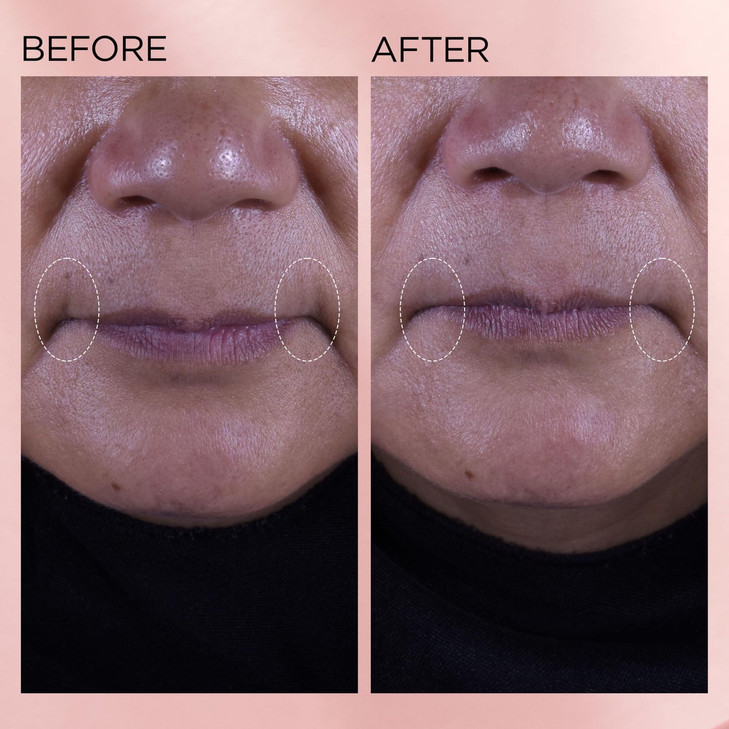 Elizabeth Arden Retinol + HPR Ceramide Rapid Skin Renewing Water Cream Face Moisturizer, Anti-Aging Wrinkle Treatment, Niacinamide, Hyaluronic Acid, Ceramides & Peptides, 1.7 fl oz - Medaid International