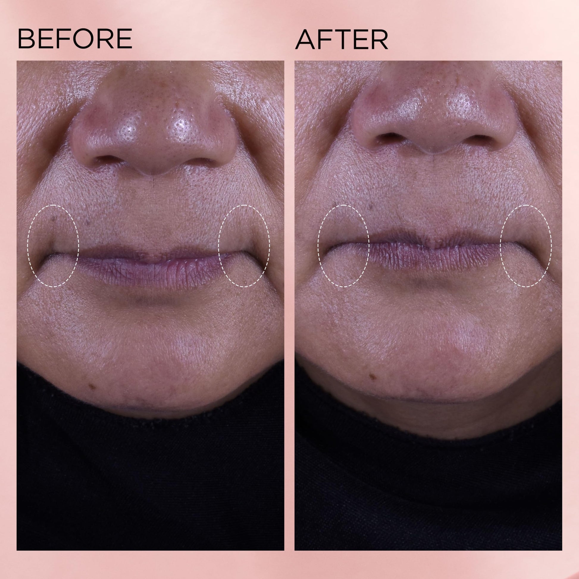 Elizabeth Arden Retinol + HPR Ceramide Rapid Skin Renewing Water Cream Face Moisturizer, Anti-Aging Wrinkle Treatment, Niacinamide, Hyaluronic Acid, Ceramides & Peptides, 1.7 fl oz - Medaid International