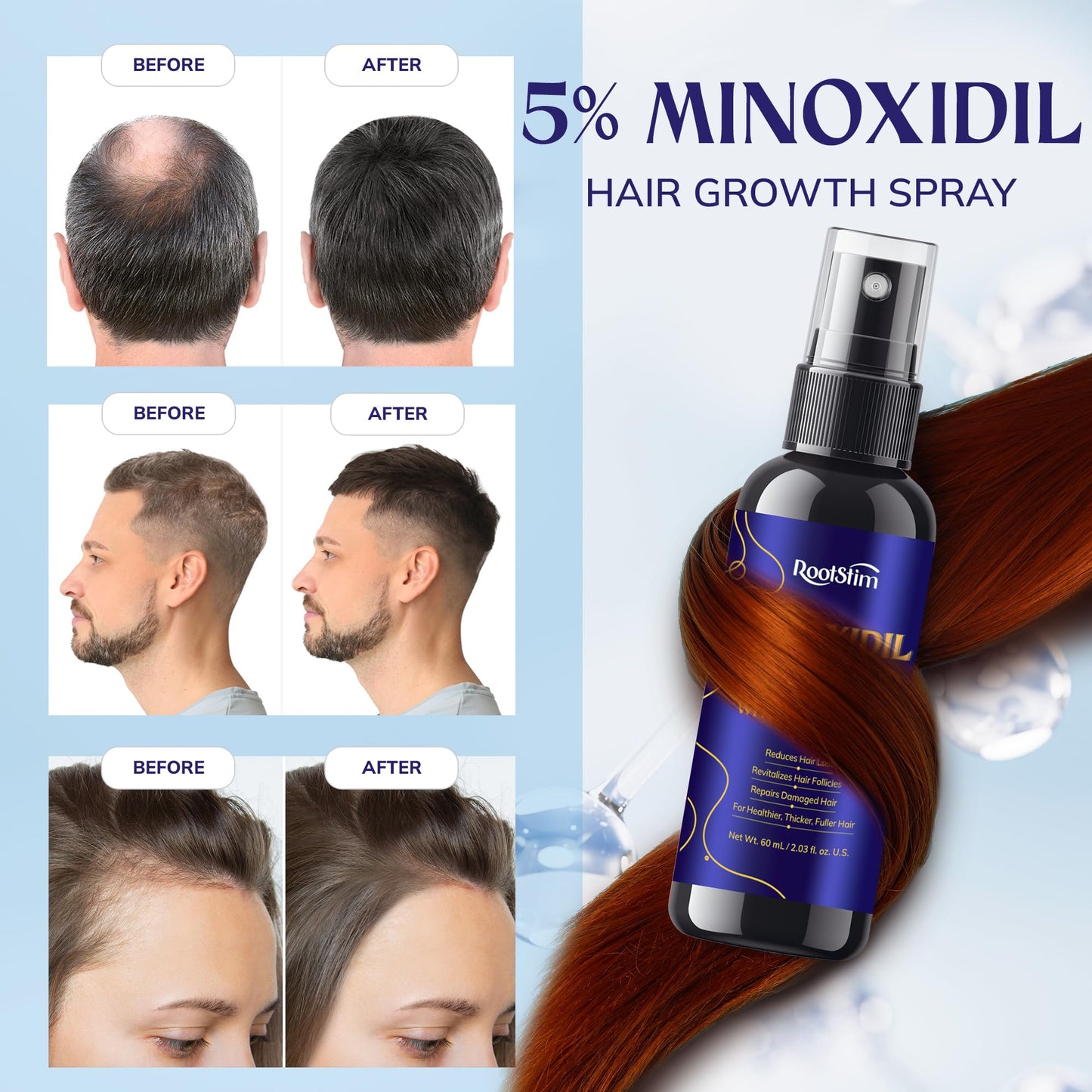 5% Minoxidil Hair Growth for Men and Women: Extra Strength Minoxidil Hair Loss Treatment Serum with Rosemary for Faster Stronger Thicker Hair Growth 60ML - Medaid International
