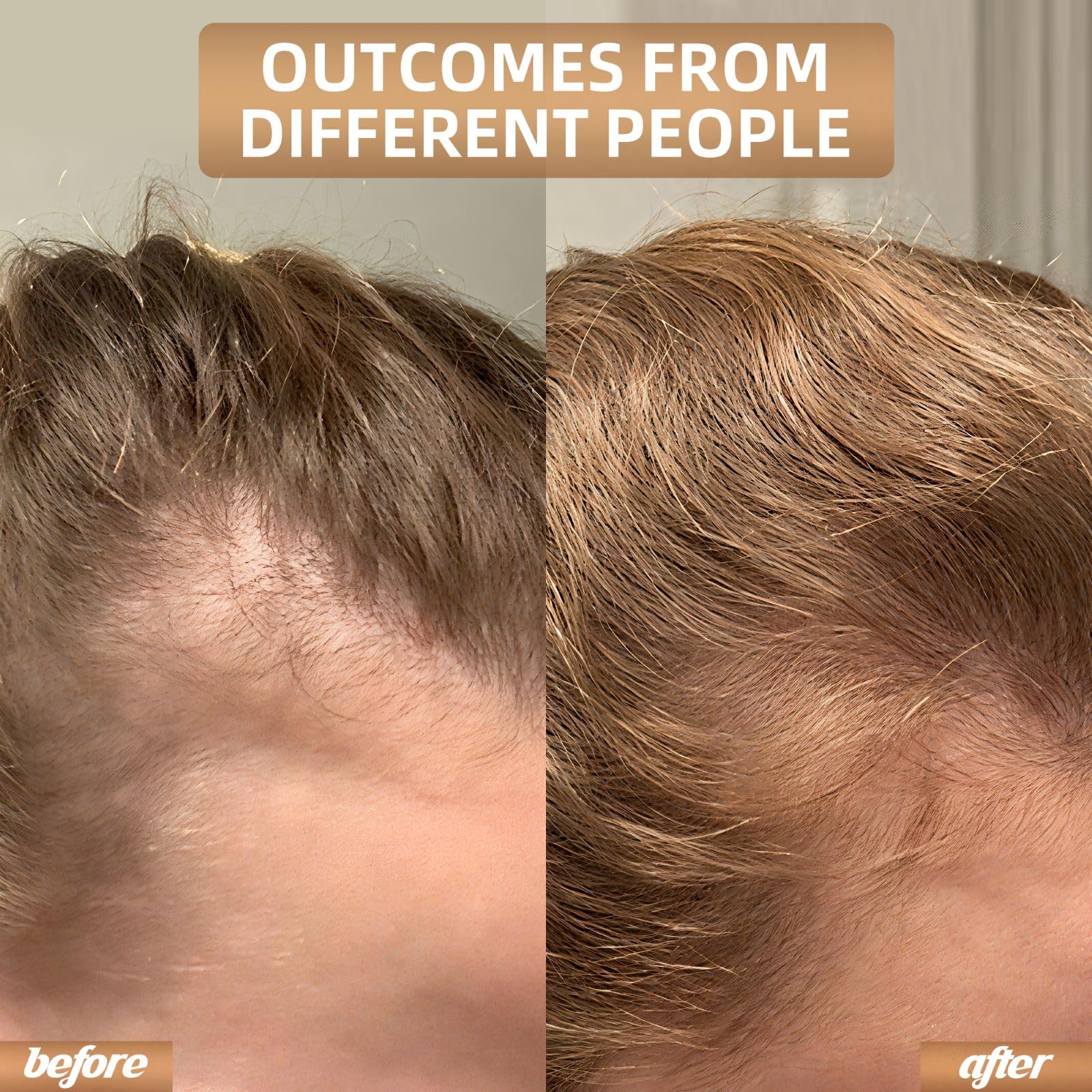 Red Light Therapy for Hair Growth, Laser Cap Hair Regrowth For Women and Men - Medaid International