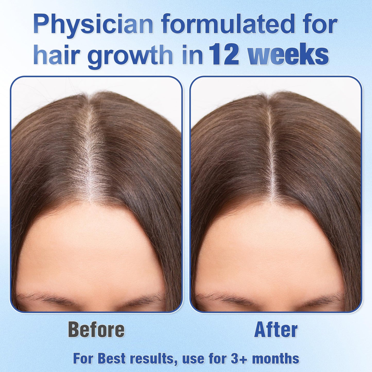 Hair Growth Serum Roll-On (25ml) – Powered by 3% Rosemary, 3% Redensyl & 2% Anagain | DHT Blocker for Stronger, Thicker Hair | Paraben/Sulfate-Free, Suitable for Men & Women - Medaid International