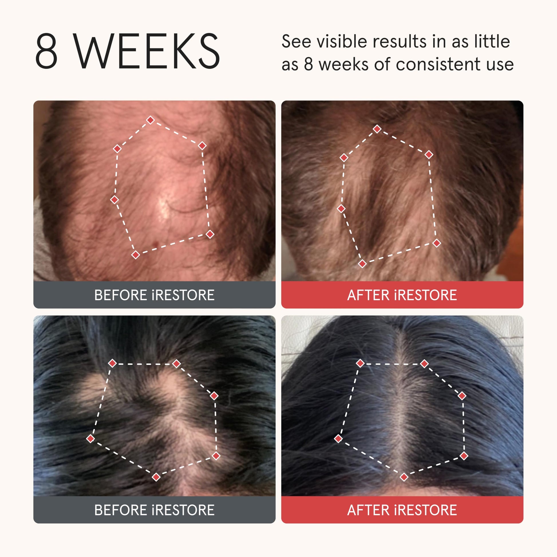 iRestore Anti Hair Loss and Thinning Shampoo - Biotin Formula for Hair Growth, Thickening and Volumizing for Men & Women - Medaid International