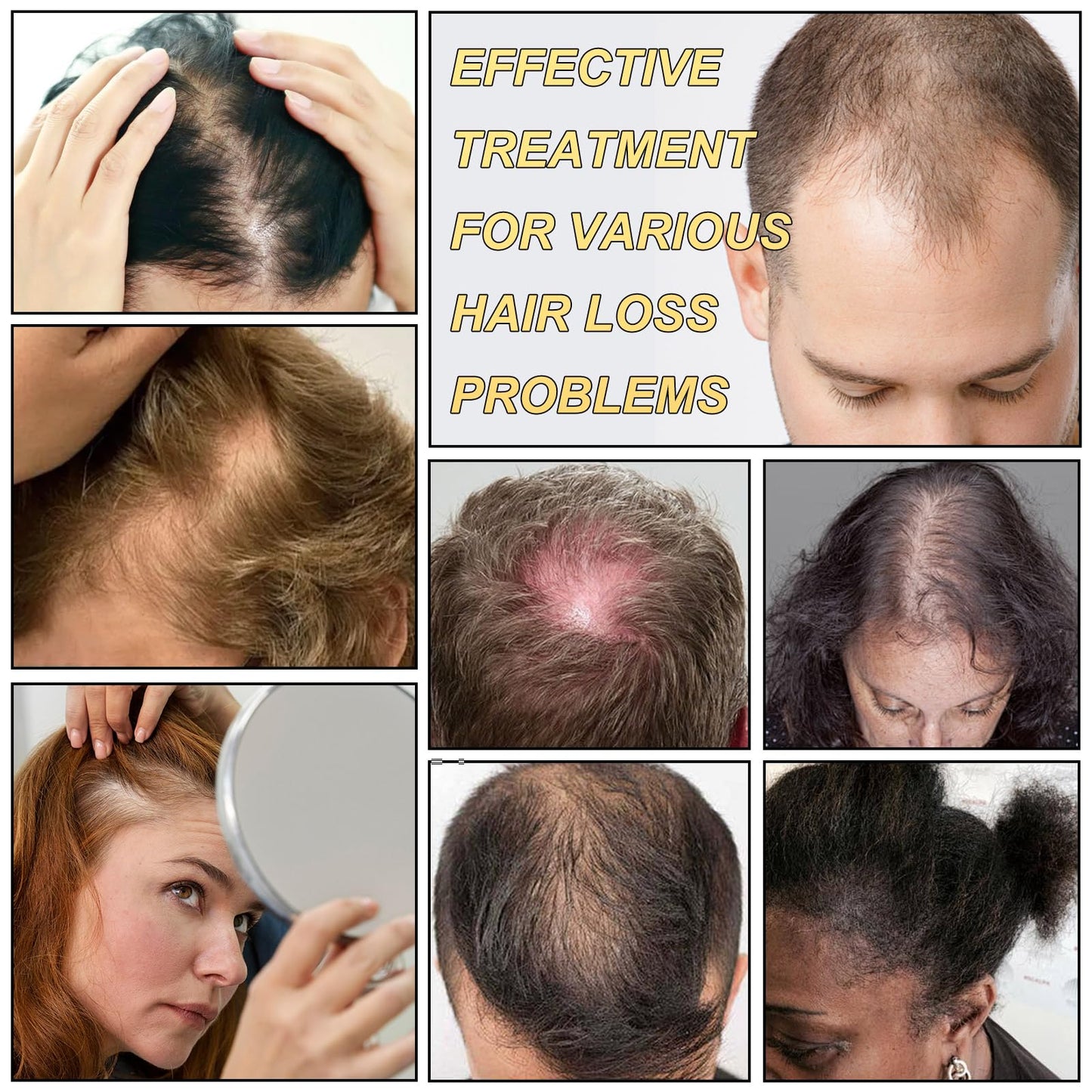 5% Minoxidil for Men and Women Hair Growth Serum, Biotin Hair Growth, Hair Regrowth Treatment for Scalp Hair Loss Hair Thinning for Thicker Longer Fuller Healthier Hair (Pack of 1) - Medaid International