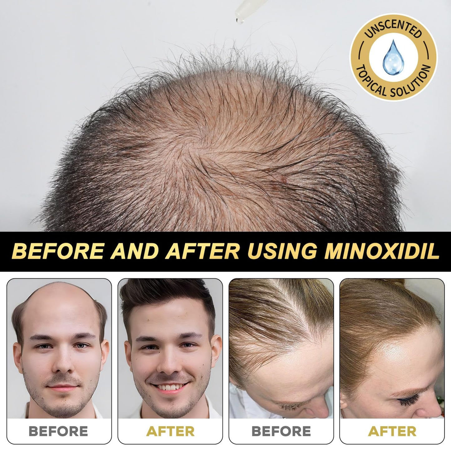 5% Minoxidil for Men and Women Hair Growth Serum, Biotin Hair Growth, Hair Regrowth Treatment for Scalp Hair Loss Hair Thinning for Thicker Longer Fuller Healthier Hair (Pack of 1) - Medaid International