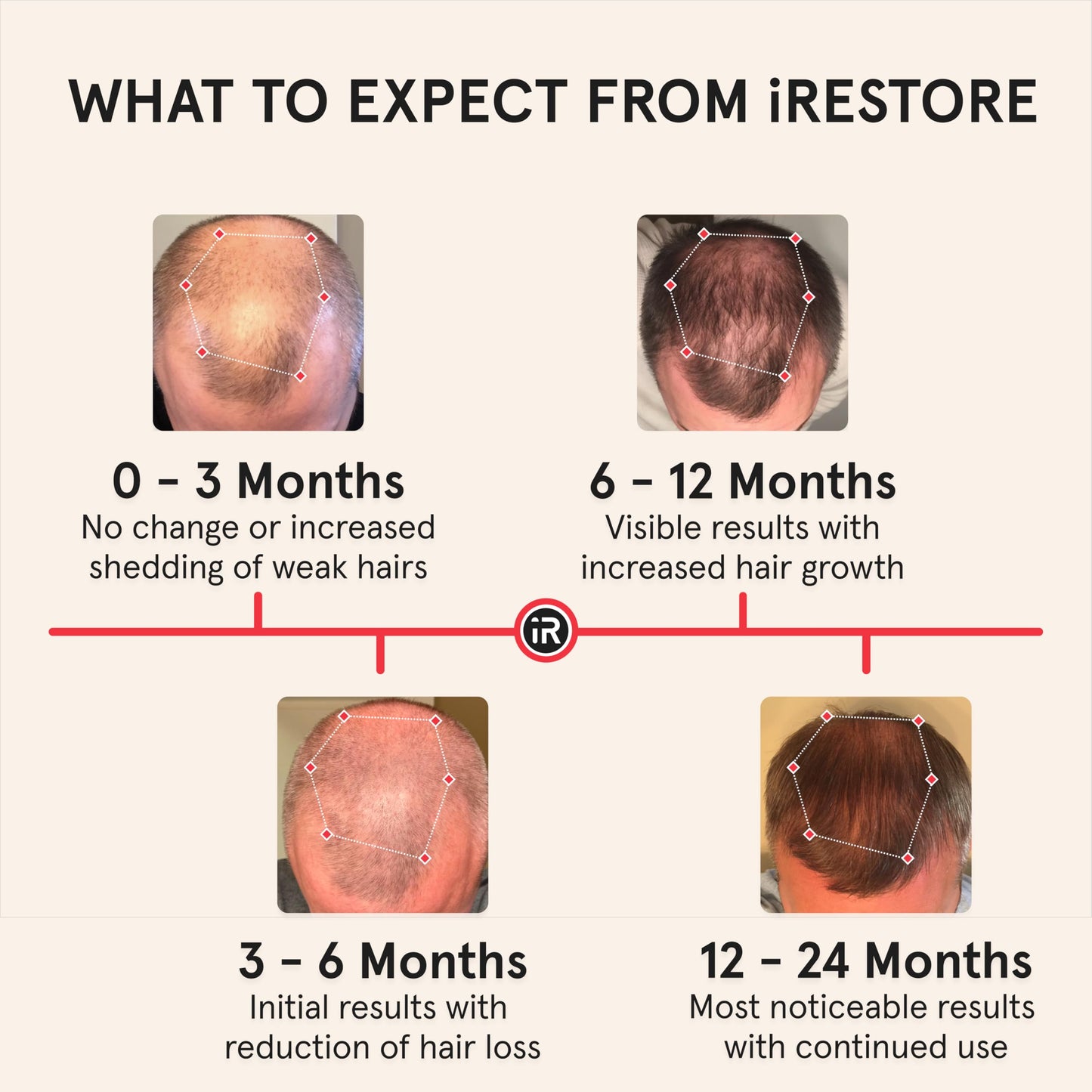 iRestore Professional + Rechargeable Battery Pack - Laser Red Light Therapy for Hair Growth - FDA Cleared Hair Loss, Thinning Treatment for Men & Women - Hair Regrowth Cap - 282 Lasers & LEDs - Medaid International