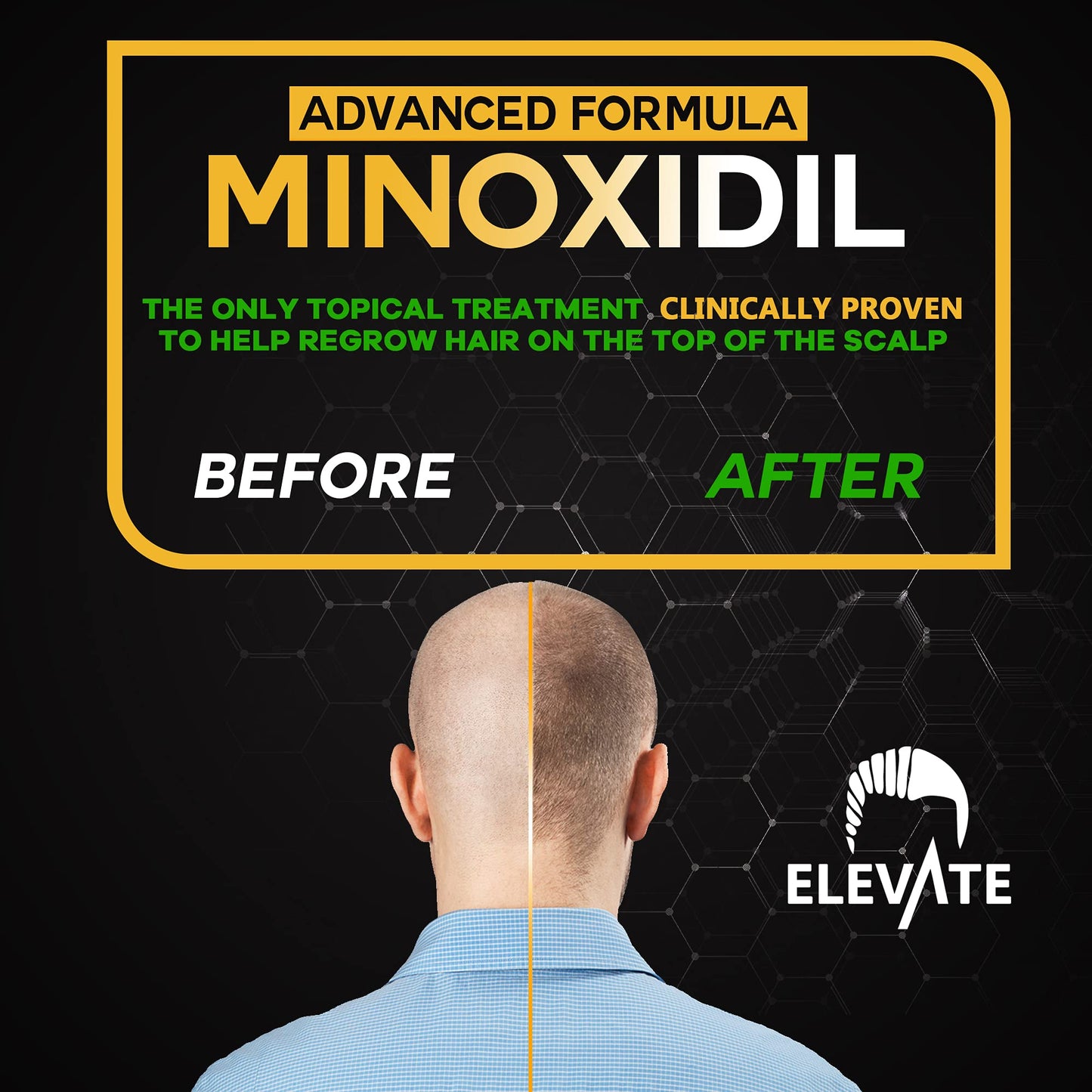 ELEVATE 5% Minoxidil Hair Growth Spray - Alcohol Free Non Oily Formula Extra Strength Professional Treatment for Hair Loss/Regrowth - Stimulate Hair Follicles for Men & Women - 1 Month Supply - Medaid International