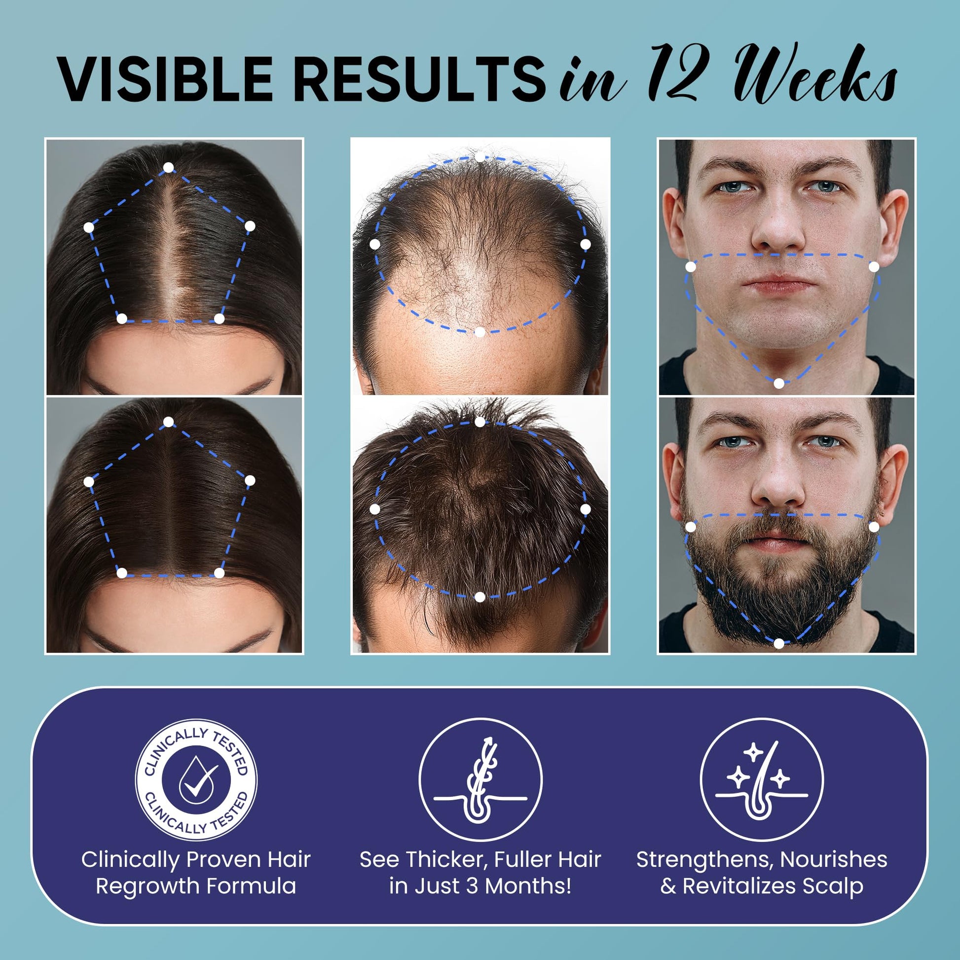 5% Minoxidil for Men and Women Hair Growth: Minoxidil Spray Hair Regrowth Treatment Serum with Biotin & Rosemary -Stop Hair Thinning and Hair Loss For Stronger Thicker Longer Hair - Medaid International