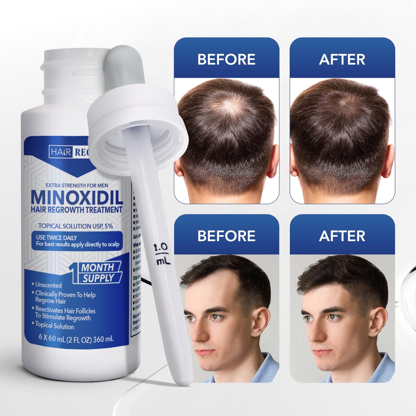 Hair-Regen Advanced 5% Minoxidil For Men Hair Regrowth Treatment for Thinning Hair - Hair Loss for Men - 6 Month Supply, Minoxidil Topical Solution So Thicker Fuller Hair Keeps Growing Amazing Results - Medaid International