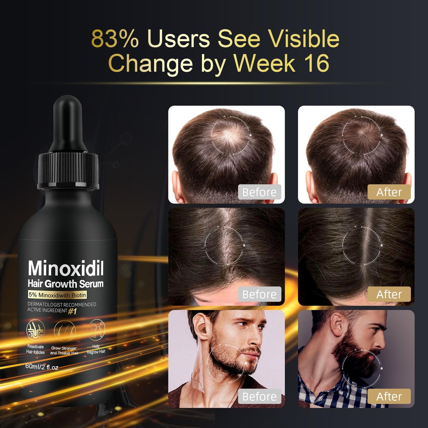 5% Minoxidil for Women Hair Growth - Hair Regrowth Treatment for Men and Women - Minoxidil Hair Growth Serum for Fuller, Thicker Hair - Medaid International