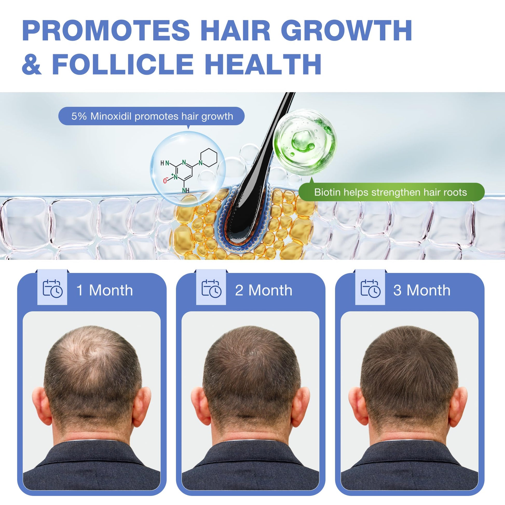 5% Minoxidil for Men, for Men & Women Hair with Biotin, Minoxidil for Beard Growth for Hair Loss to Hair Regrowth Get Thicker Fuller, Hair Loss Treatments for Women 100ml - Medaid International