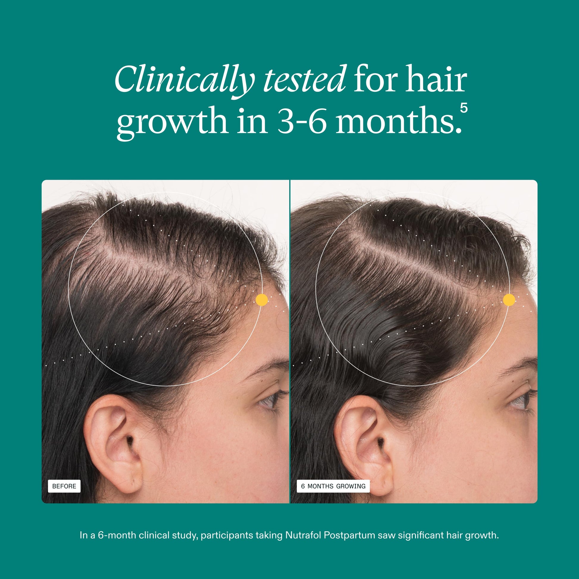 Nutrafol Postpartum Hair Growth Supplements, Clinically Tested for Visibly Thicker Hair and Less Shedding, Breastfeeding-friendly - 1 Month Supply - Medaid International