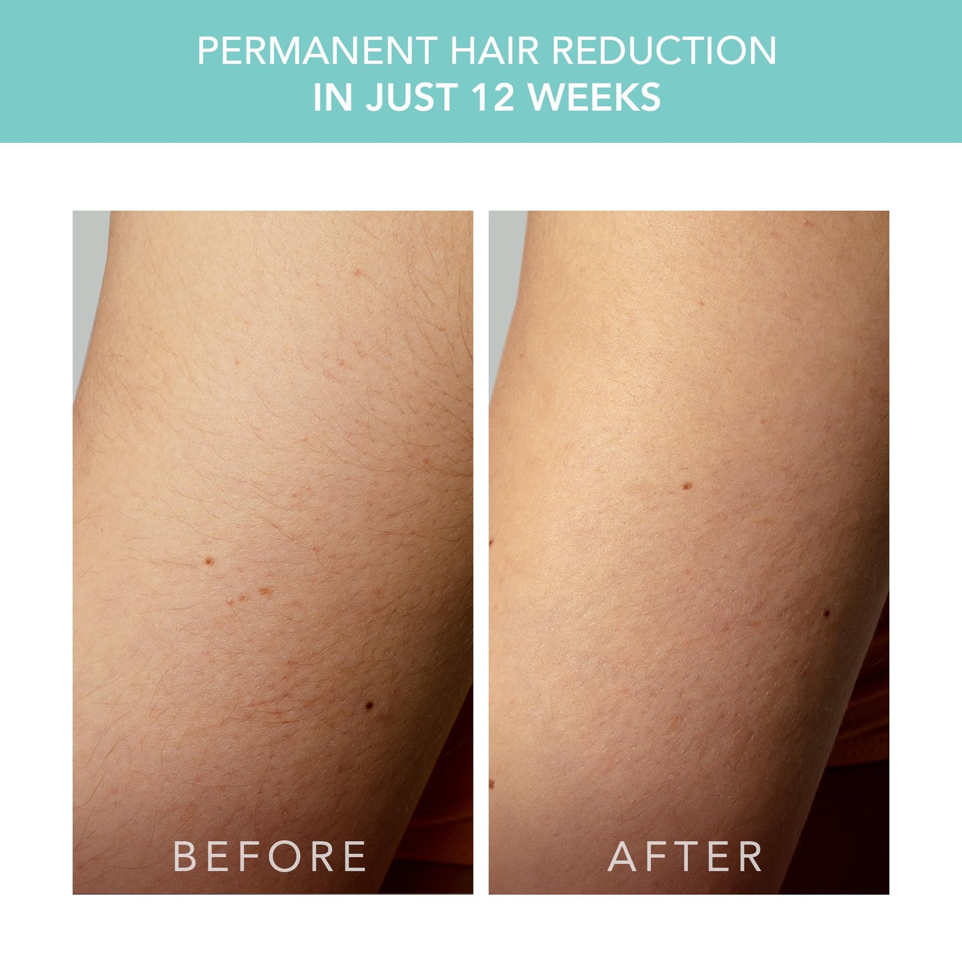 FOREO Peach 2 go IPL Hair Removal Device - Travel-Friendly Permanent Hair Removal - Laser Hair Removal - Body & Face - Painless Hair Removal - Skin Cooling & Silicone Shield - Customizable Artic Blue - Medaid International