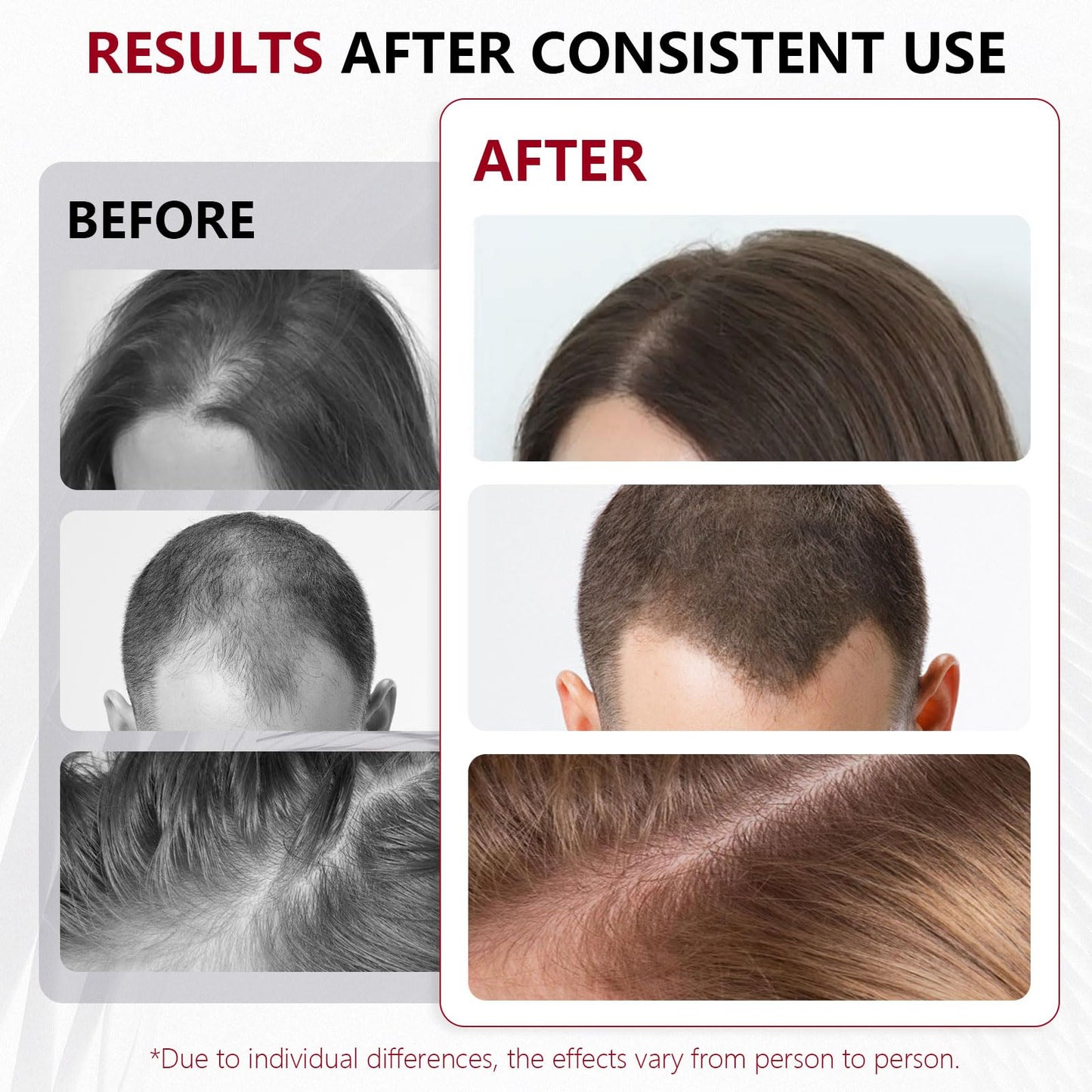 Laser Cap, Laser Therapy Device for Hair Regrowth, Low Level Laser Therapy to Promote Hair Growth in Women and Men with Androgenic Alopecia - Medaid International