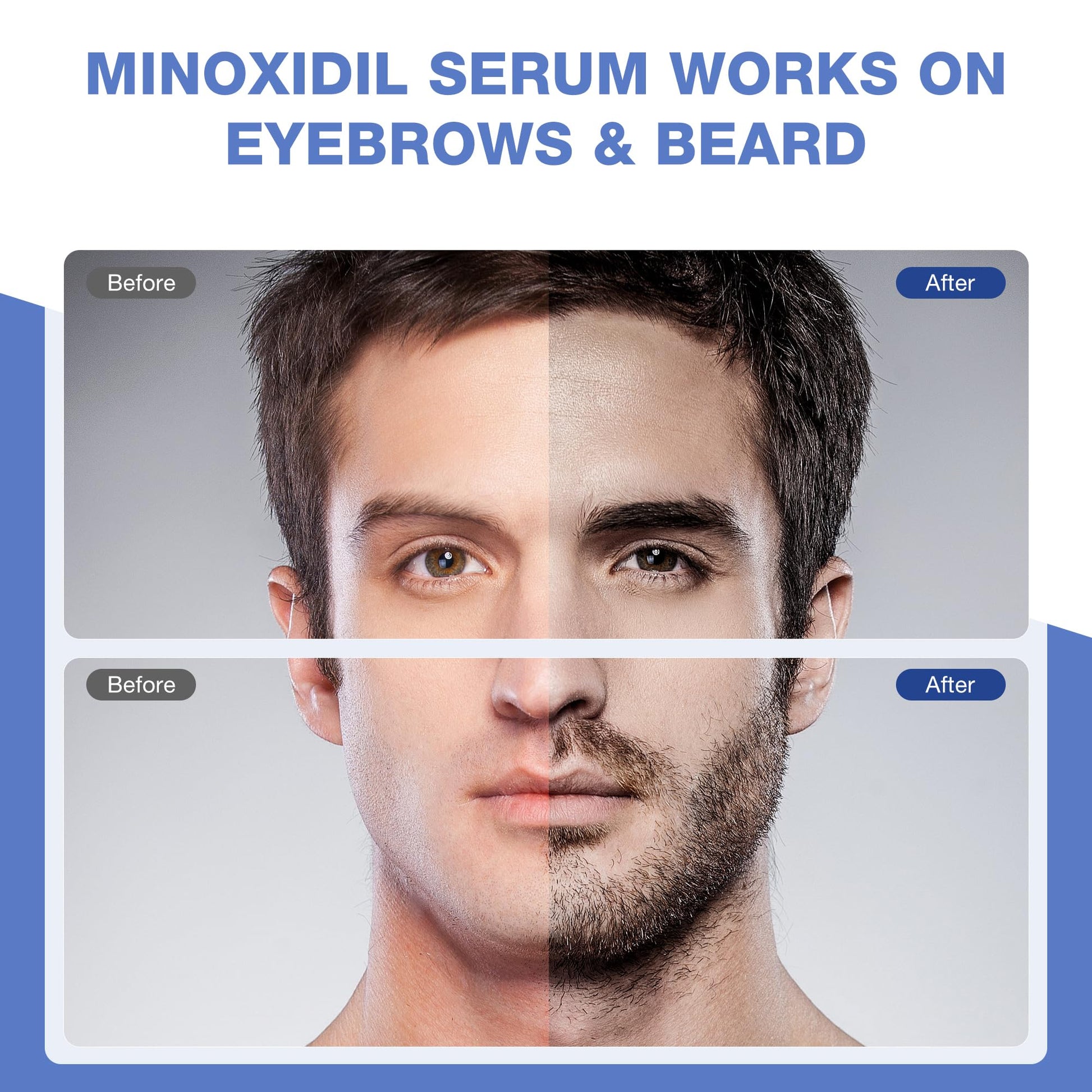 5% Minoxidil for Men, for Men & Women Hair with Biotin, Minoxidil for Beard Growth for Hair Loss to Hair Regrowth Get Thicker Fuller, Hair Loss Treatments for Women 100ml - Medaid International