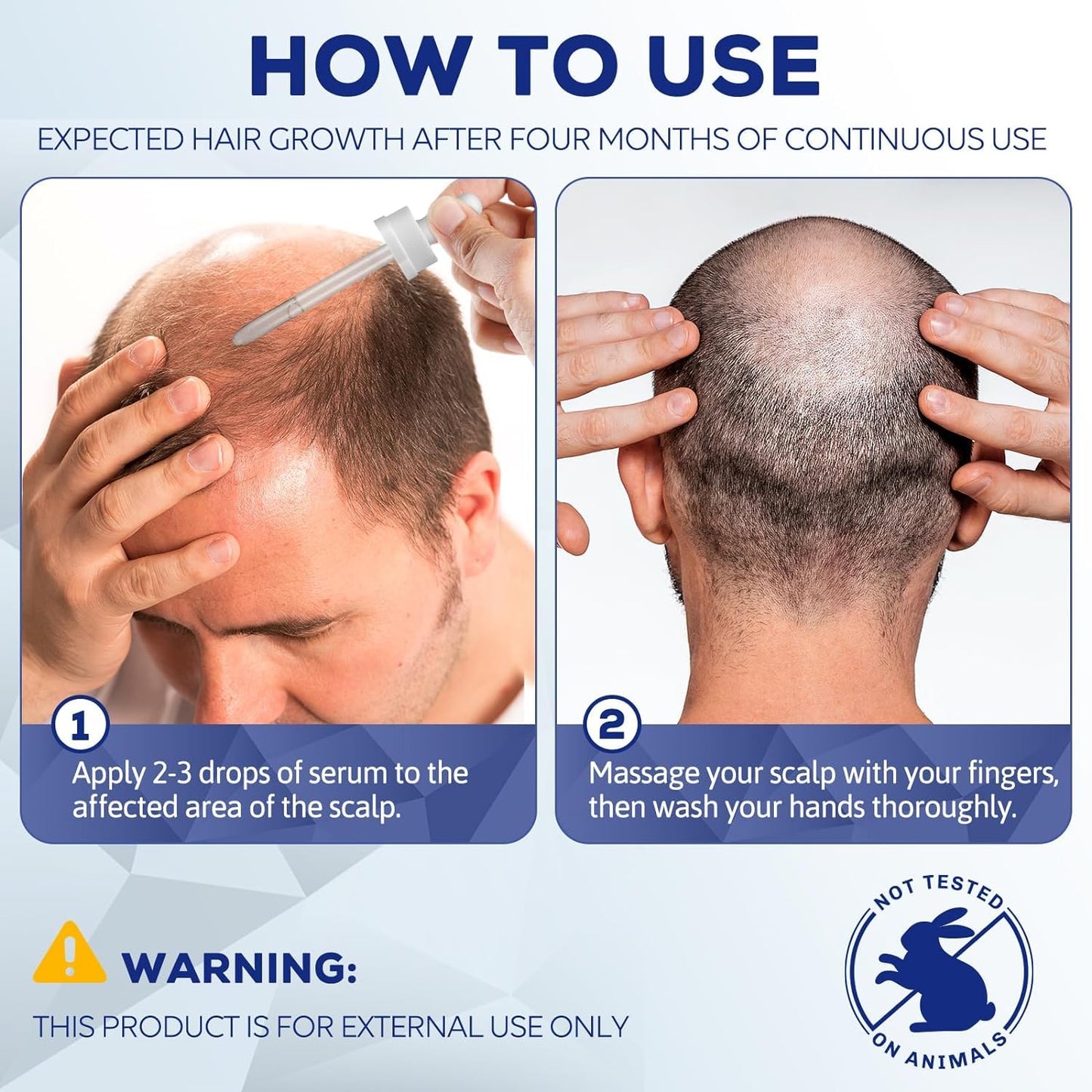 5% Minoxidil for Men and Women, Hair Regrowth Treatment for Thinning Hair and Hair Loss, Topical Solution - 1 Months Supply - Dermatologist recommended (Pack of 1) - Medaid International