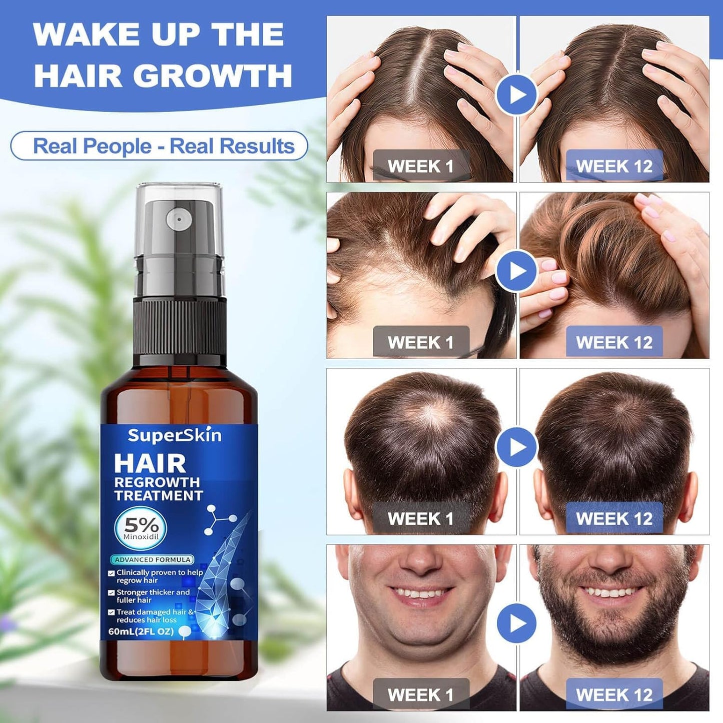 5% Minoxidil Hair Growth Serum For Men and Women 60Ml Hair Regrowth Treatment Spray For Stronger Thicker Longer Hair Help to Stop Thinning and loss hair 1 Month supply - Medaid International