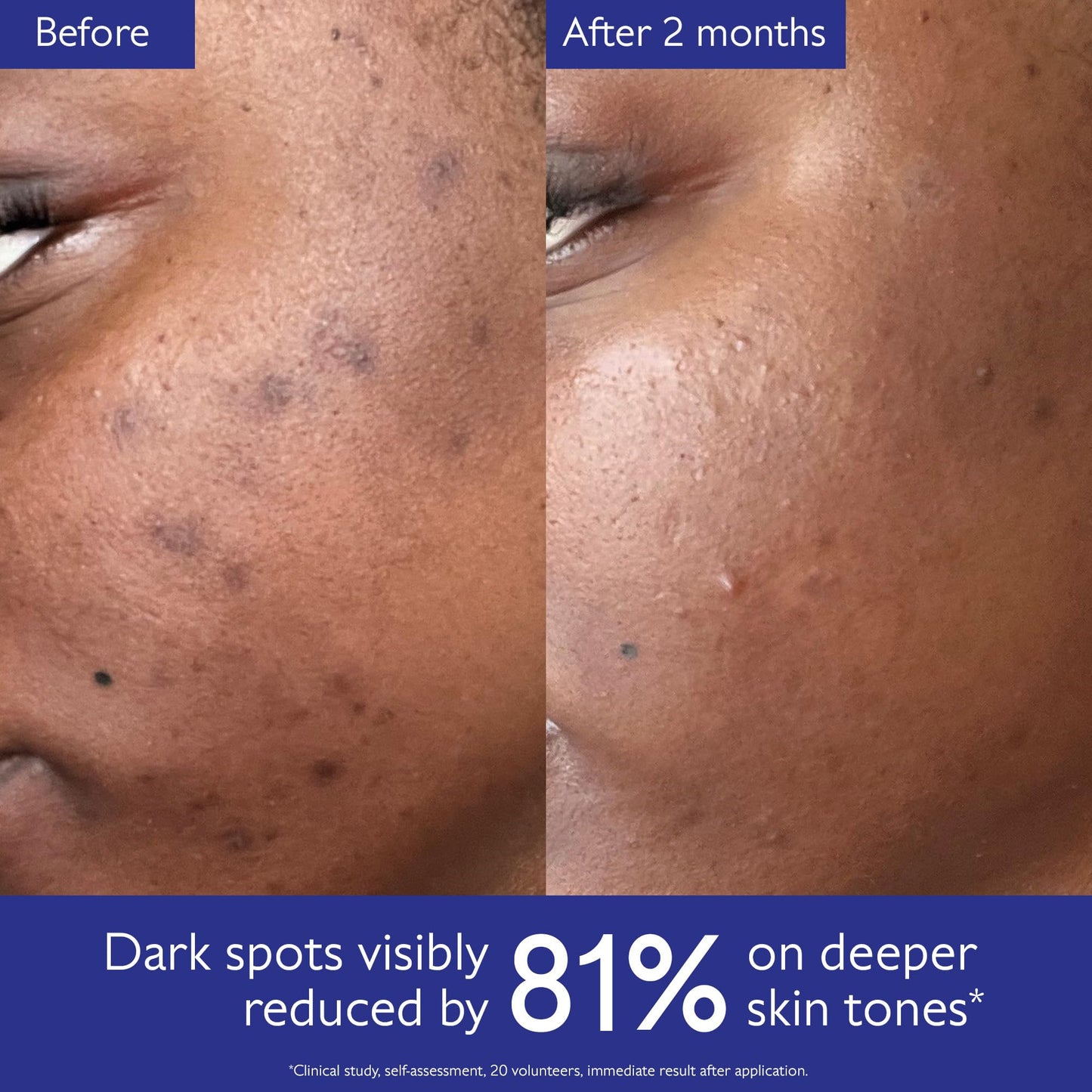 Caudalie Vinoperfect Brightening Dark Spot Serum Vitamin C Alternative - 62x More Effective than Vitamin C with Viniferine for a Visibly Brighter Even Complexion, 30 mL - Medaid International