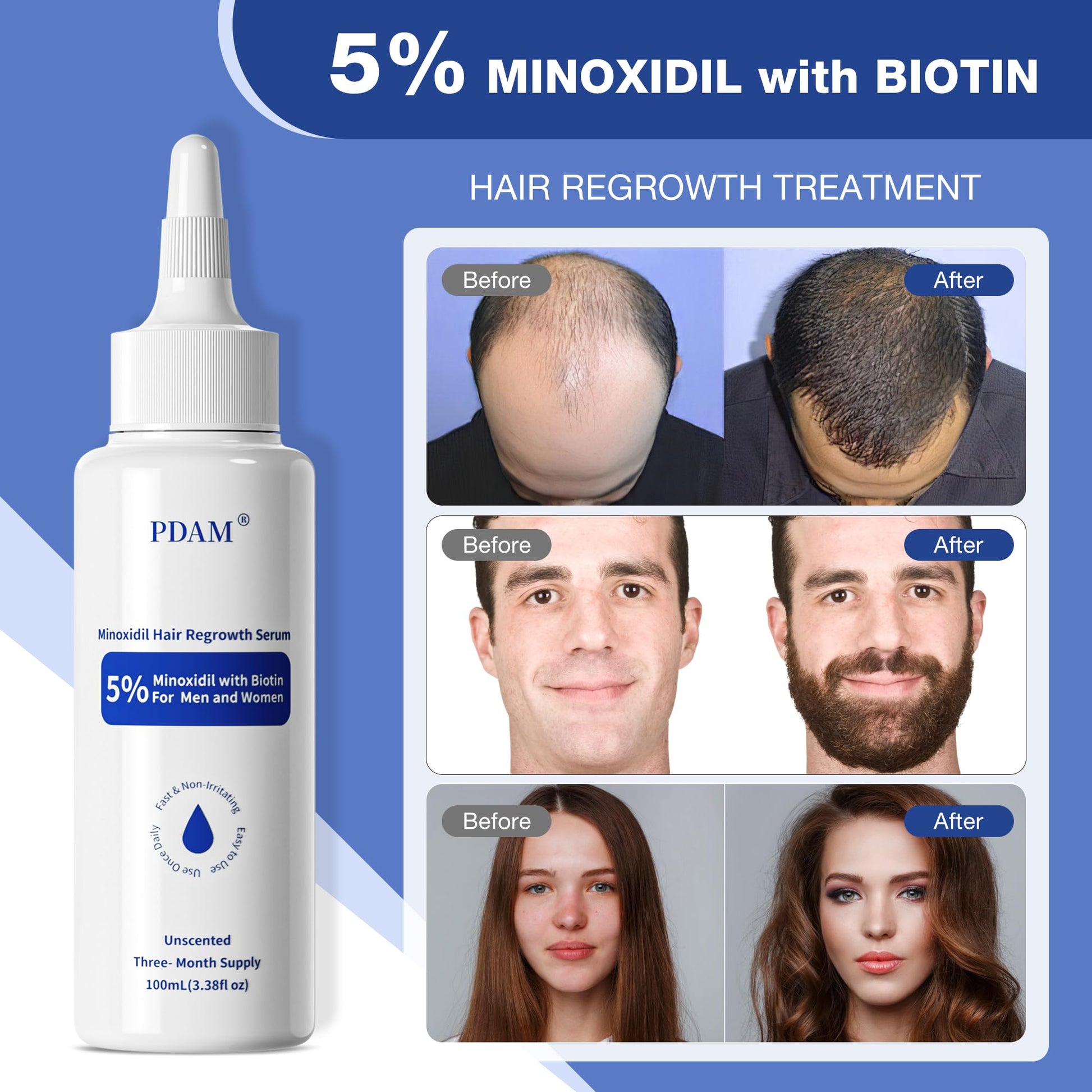 5% Minoxidil for Men, for Men & Women Hair with Biotin, Minoxidil for Beard Growth for Hair Loss to Hair Regrowth Get Thicker Fuller, Hair Loss Treatments for Women 100ml - Medaid International