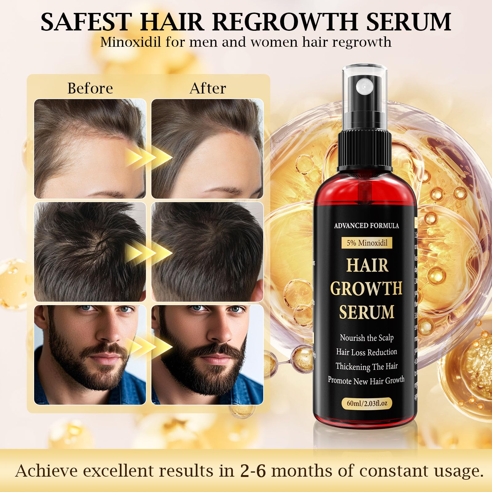 5% Minoxidil for Men/Women Hair Growth Serum Spray,Thinning Hair Loss/Regrowth Treatment for Women/Men,Minoxidil for Men’s Beard,Contain Rosemary Oil,Batana Oil for Hair Growth,Gentler,Refreshing 60ml - Medaid International