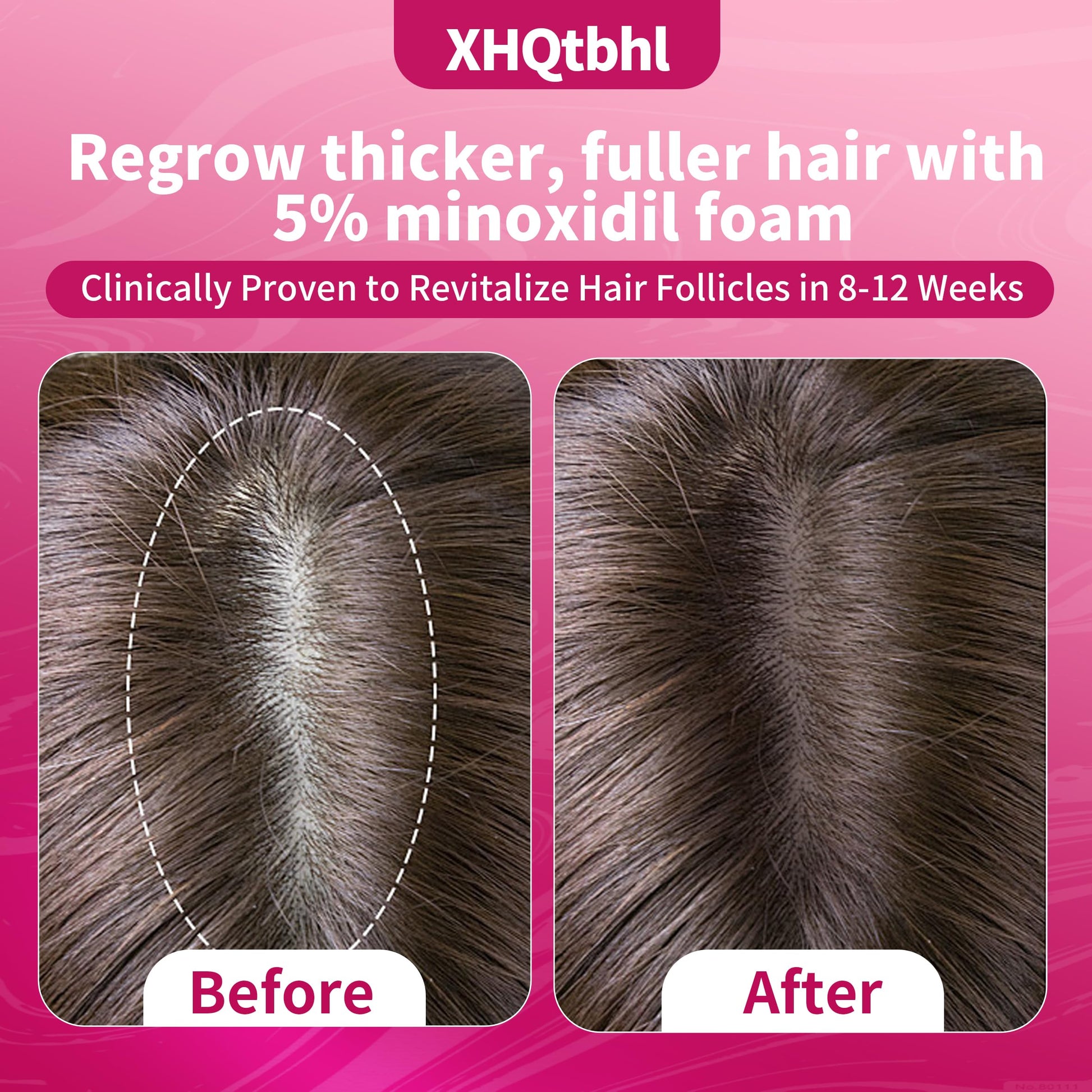 5% Minoxidil Foam for Women Hair Growth: Extra Strength Hair Regrowth Treatment – Revitalize Hair Follicles & Regrow Thicker, Fuller Hair -2 bottles - Medaid International