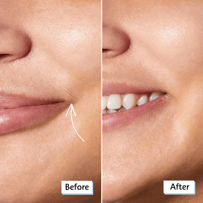 Women Facial Hair Removal | 3-in-1 - Medaid International