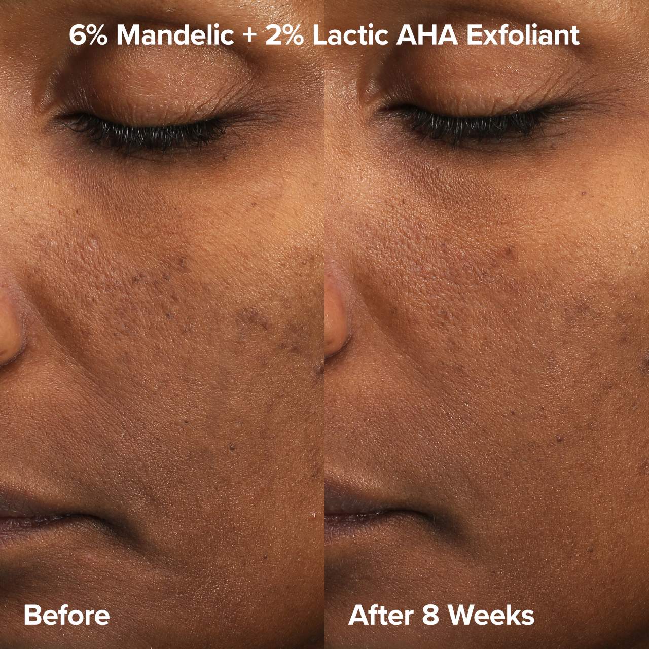 Paula's Choice - The Exfoliation Experience Kit with 2% BHA + 6% Mandelic Acid AHA - Medaid